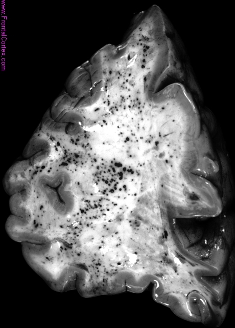  Innumerable pericapillary hemorrhages secondary to cerebral fat embolization